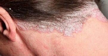 Nấm da đầu là tình trạng nhiễm nấm ở da đầu, nang tóc và thân tóc, thường gây ngứa, bong vảy và rụng tóc. 