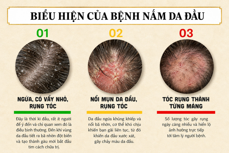 Các dấu hiệu nấm da đầu thường dễ bị nhầm với gàu, nhưng có thể kèm rụng tóc từng mảng và viêm đỏ. 